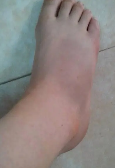 栀乳散善治跌打损伤、扭伤，患处青紫或血肿