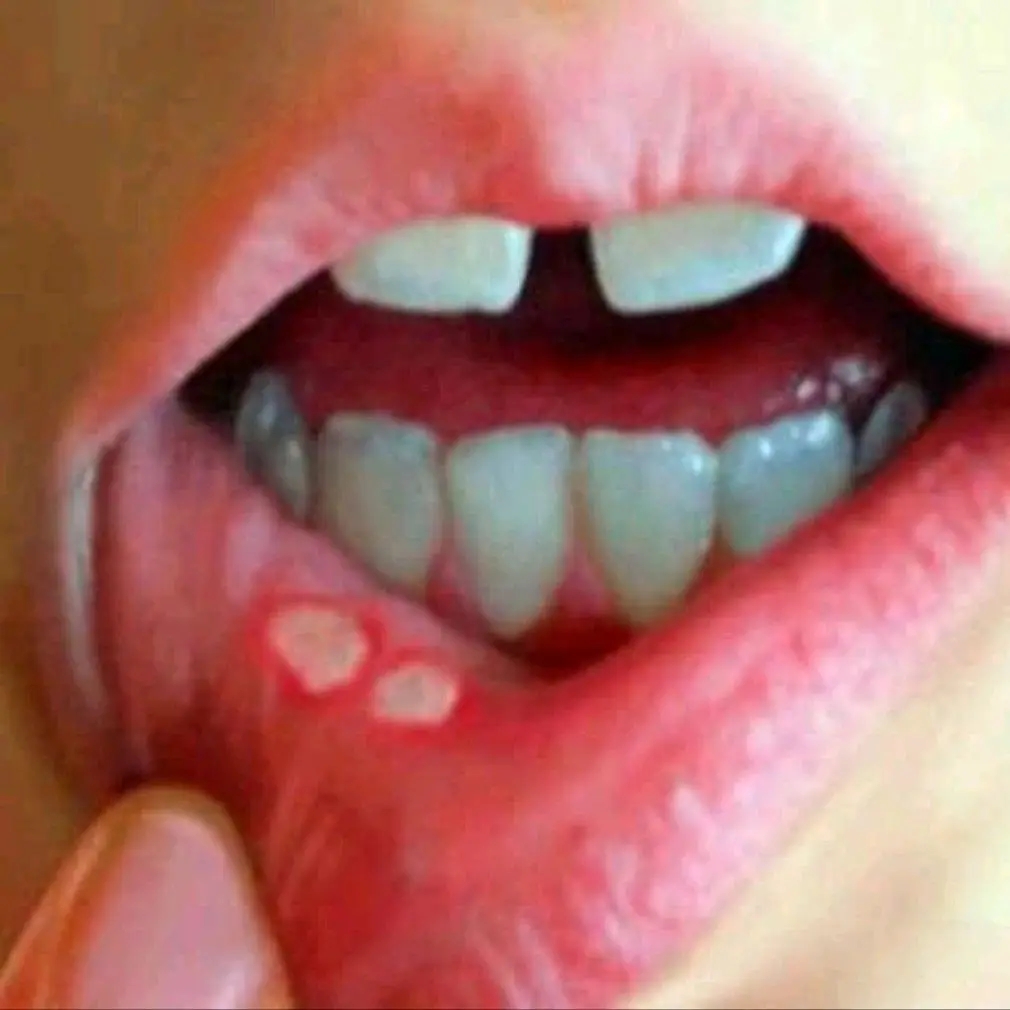 甘草泻心汤：上热下寒型的复发性口腔溃疡效方